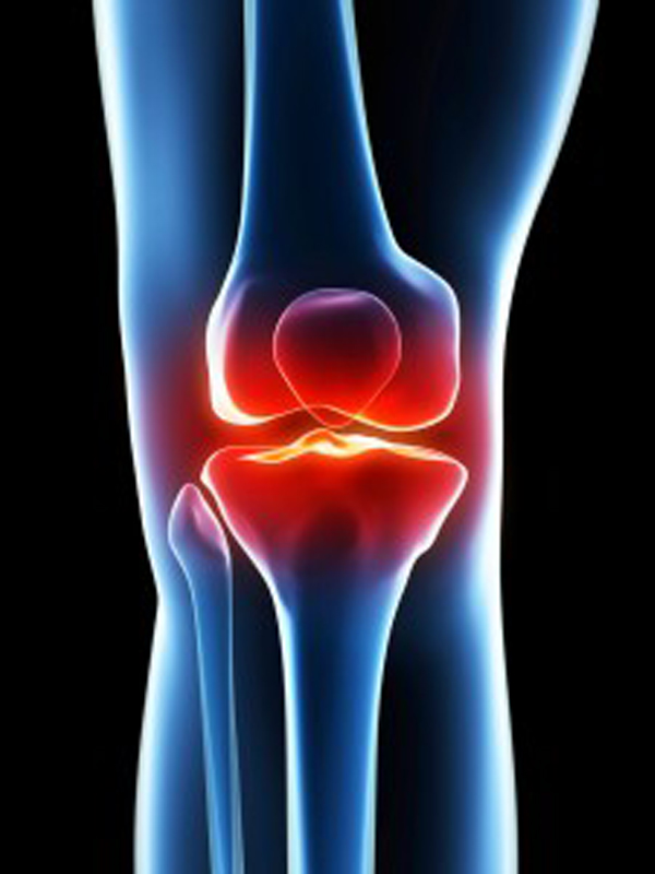 arthritis-knee
